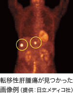 転移性肝腫瘍が見つかった画像例（提供：日立メディコ社）