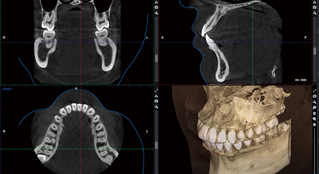 ３Dエックス線撮影（CBCT）